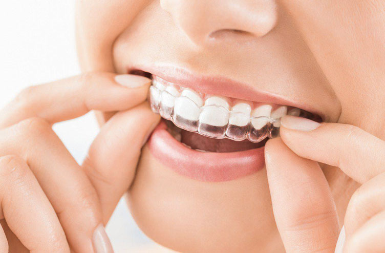 Read more about the article The Ultimate Guide to Invisalign
