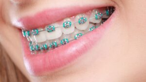 braces or invisalign